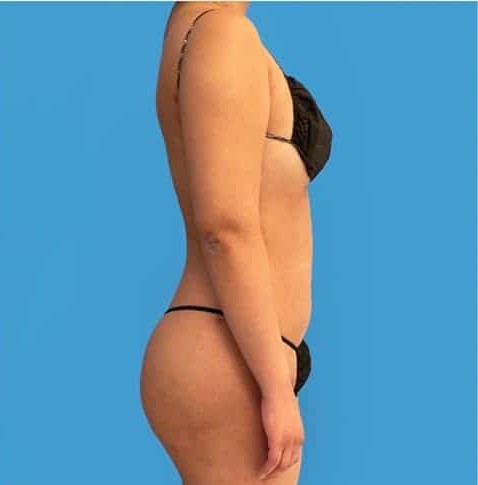 liposuction-après