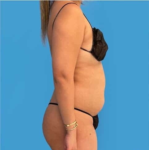 liposuction-avant