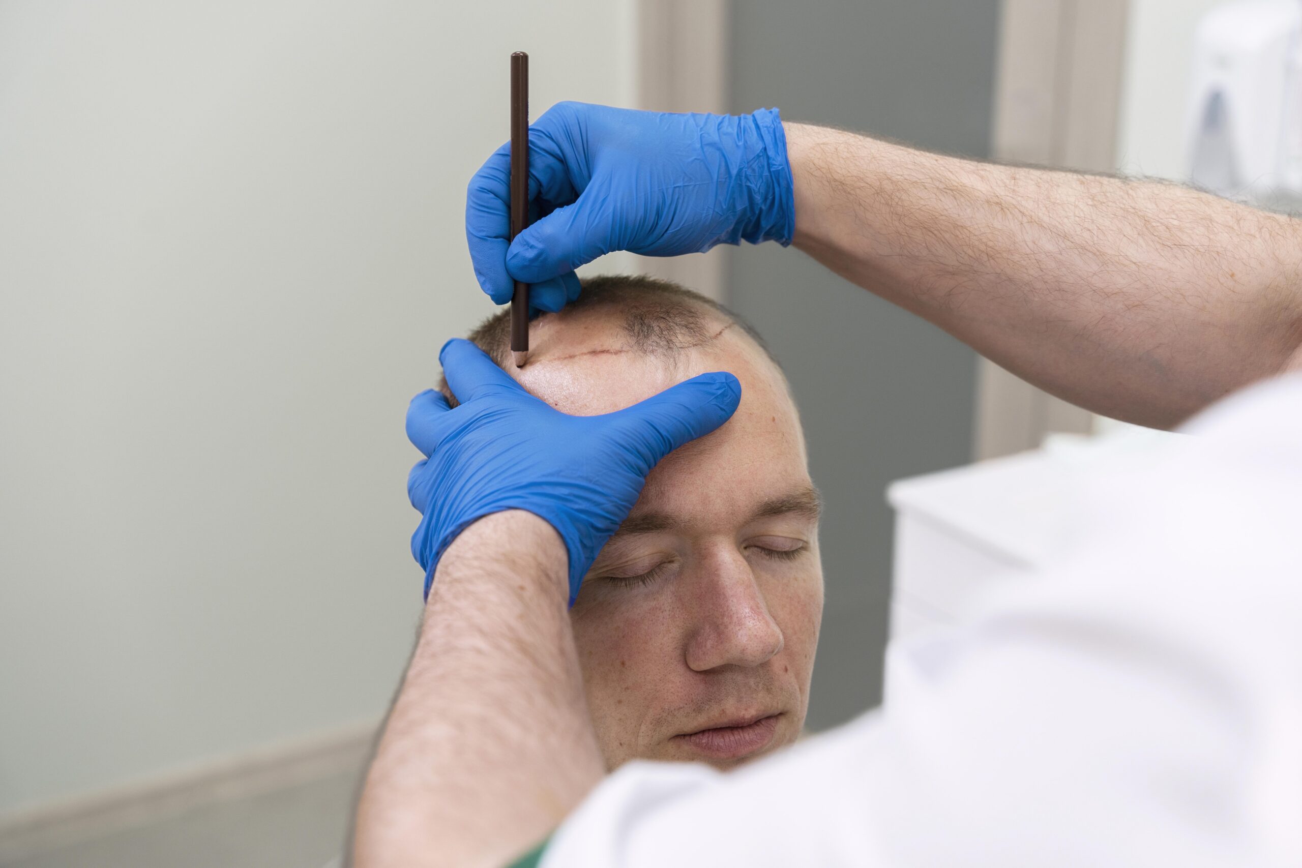 Homme ayant des problèmes de calvitie