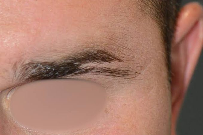 greffe-de-sourcils homme