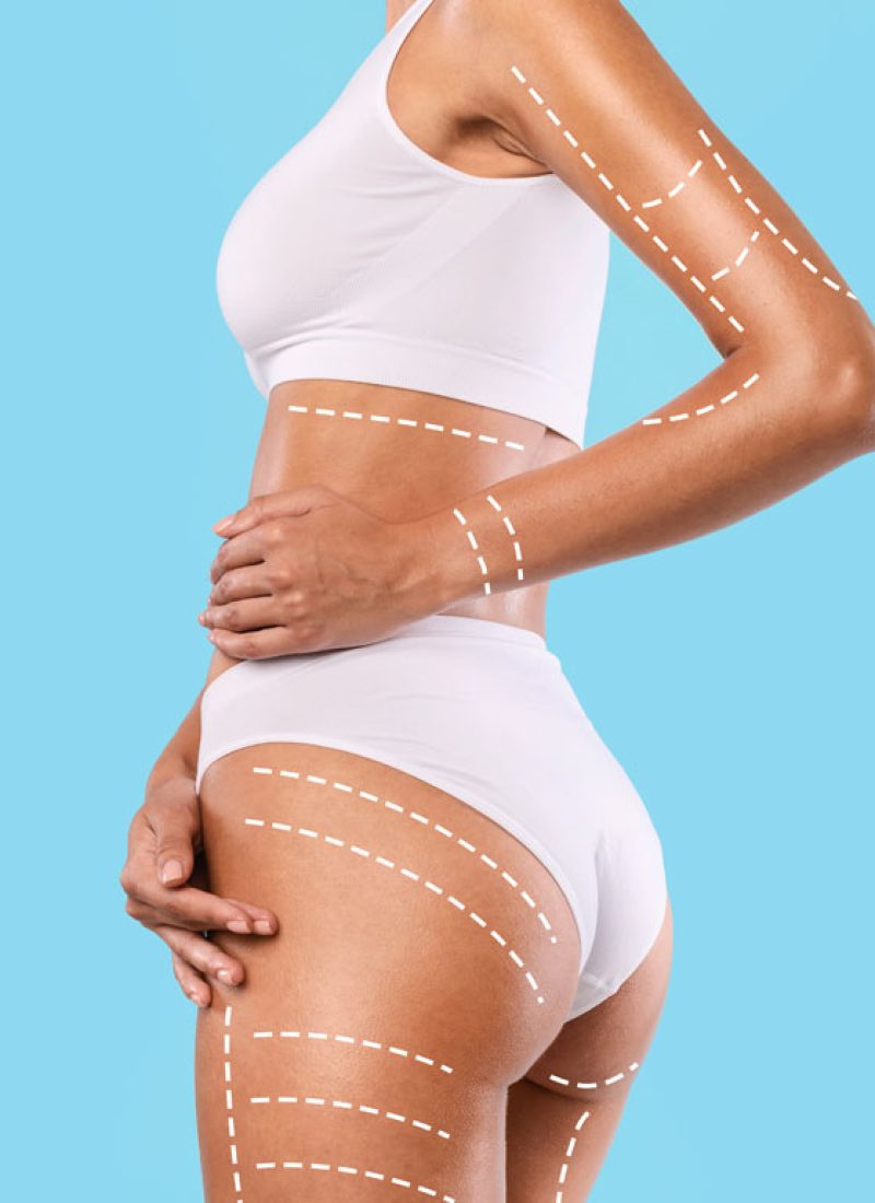 liposuccion- chirurgie esthétique de silouhette
